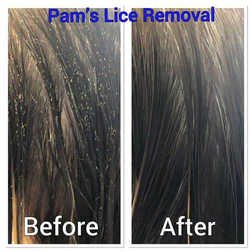 The Complete Lice Removal System